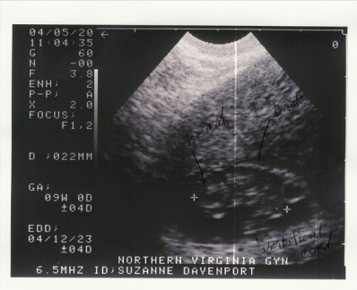 sonogram1